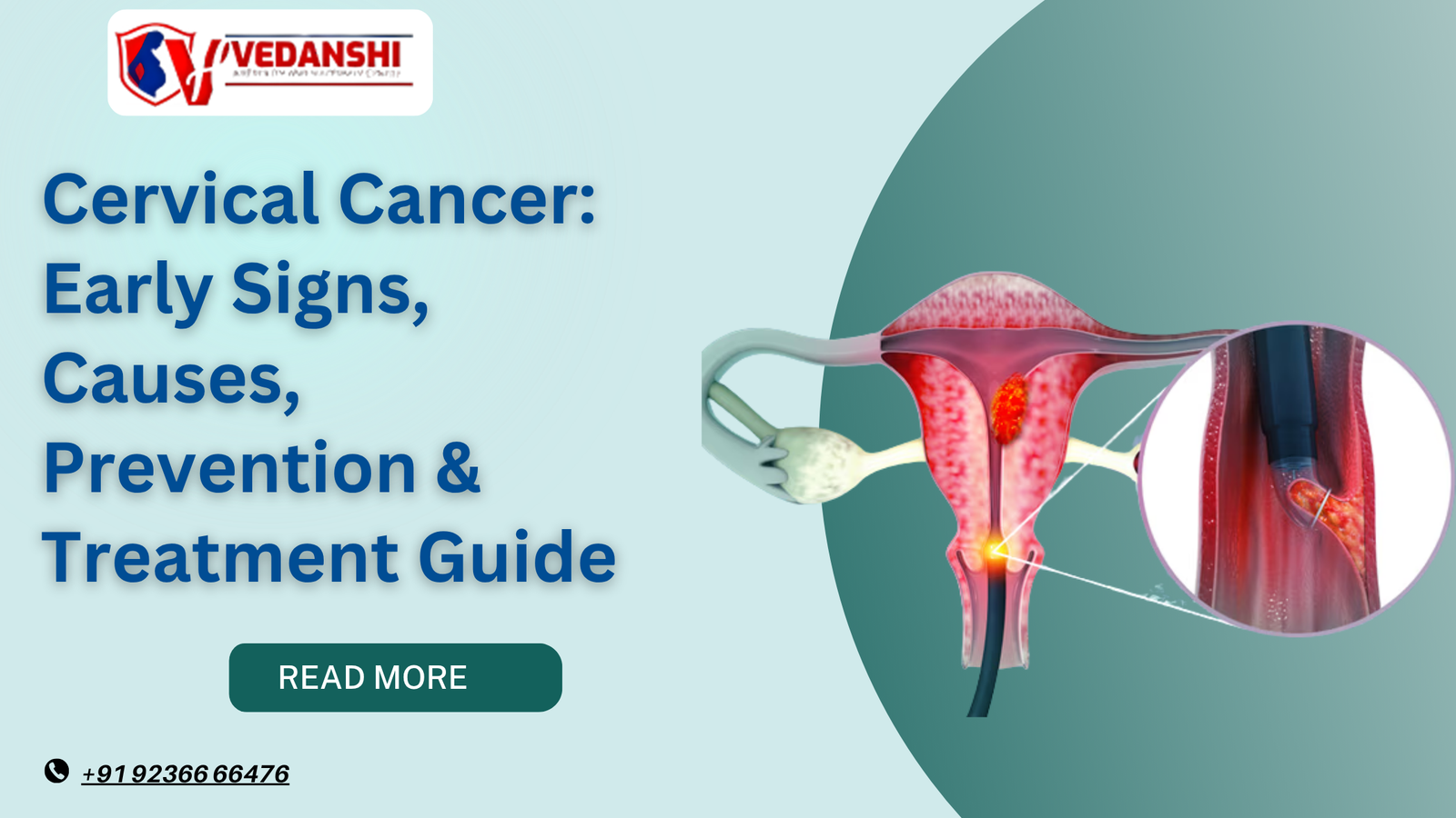 Cervical Cancer: Early Signs, Causes, Prevention & Treatment Guide